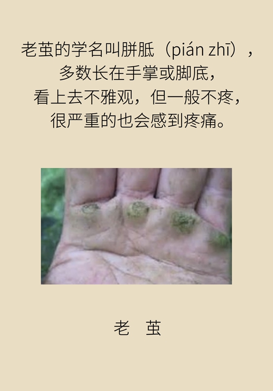 長了雞眼和老繭怎么辦,？這份防治指南請收好