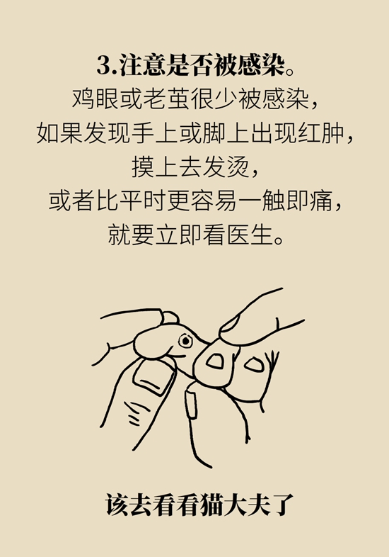 長了雞眼和老繭怎么辦？這份防治指南請收好