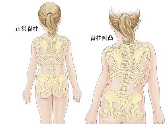 青少年睡姿不對，真能把脊柱睡“彎”嗎,？