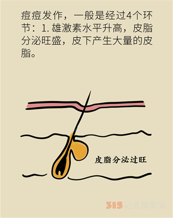 拯救顏值，請收下這份戰(zhàn)痘寶典,！