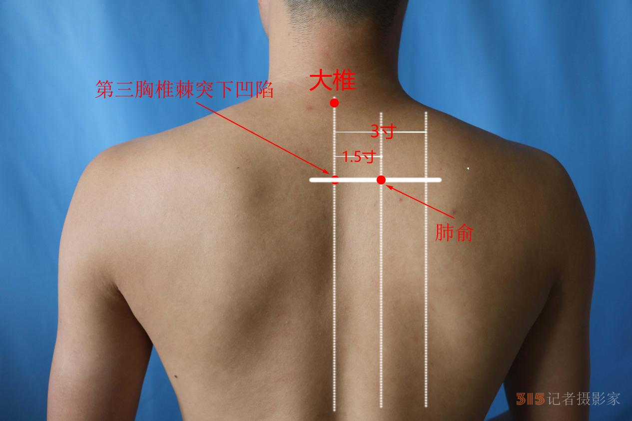 慢性咽炎不要慌,，可用艾灸來幫忙