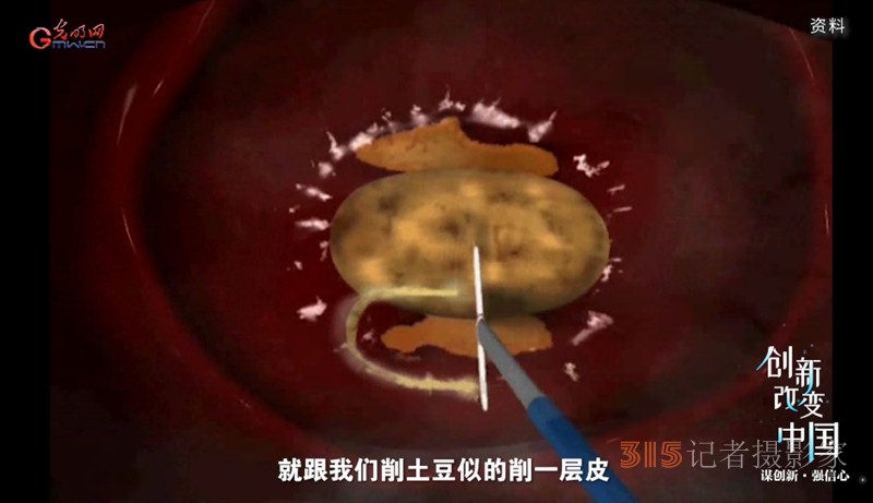 宮頸癌消滅戰(zhàn):如何減少“梅艷芳式悲劇”? 宮頸癌消滅戰(zhàn):如何減少“梅艷芳式悲劇”,?